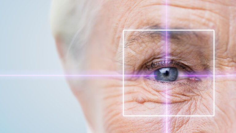 Laser Cataract Surgery