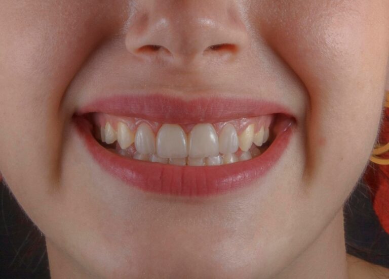 How to Care for Your Dentures: A Comprehensive Guide
